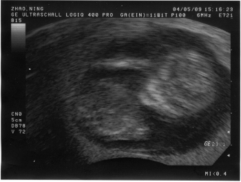 090504_ultraschall-300dpi-350px baby at 12th week